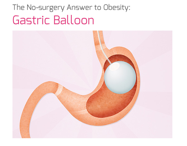 The No-surgery Answer to Obesity: Gastric Balloon