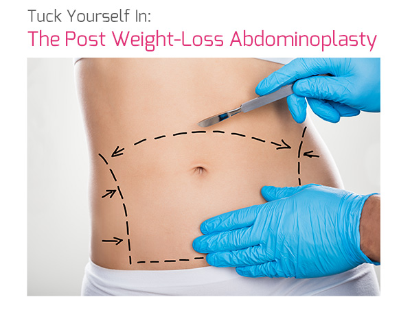 Tuck Yourself In: The Post Weight-Loss Abdominoplasty