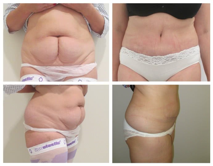 Before x After Abdominoplasty 1