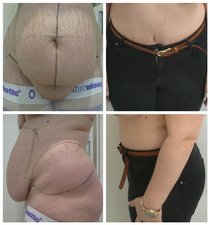 Before x After Abdominoplasty 3