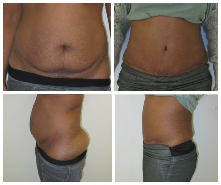 Before x After Abdominoplasty 2