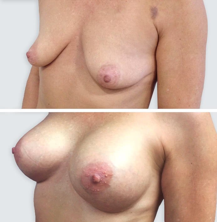 breast implants 7