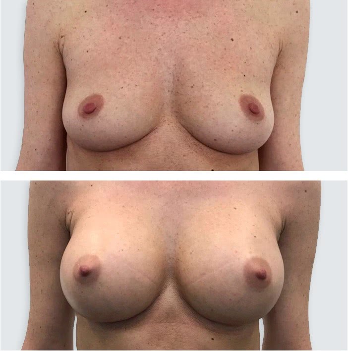 breast implants 8