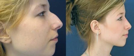 Nose surgery 1