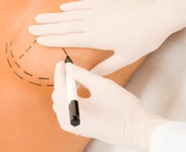 Breast Augmentation: Implants vs. Fat Transfer