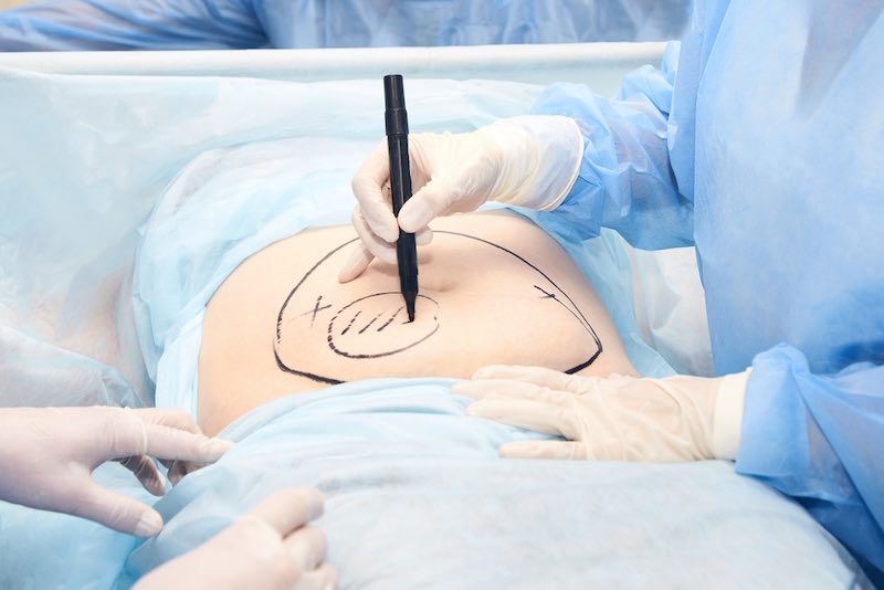 liposuction fat