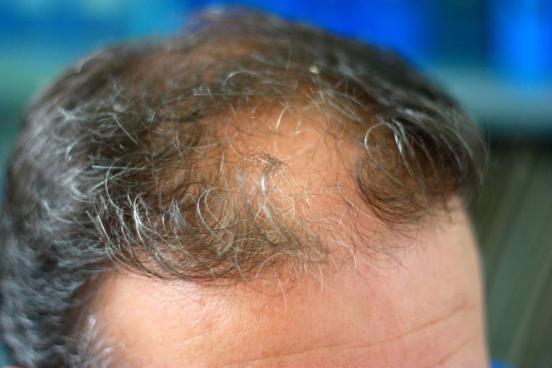 hair loss