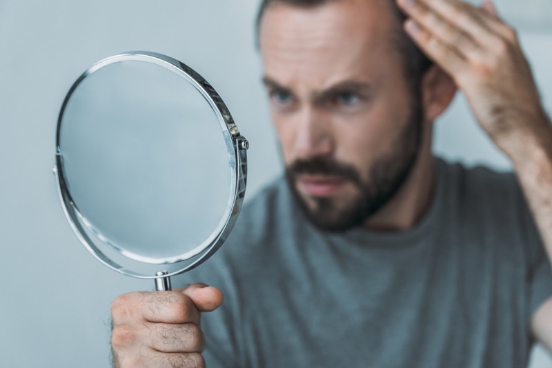 Baldness in men