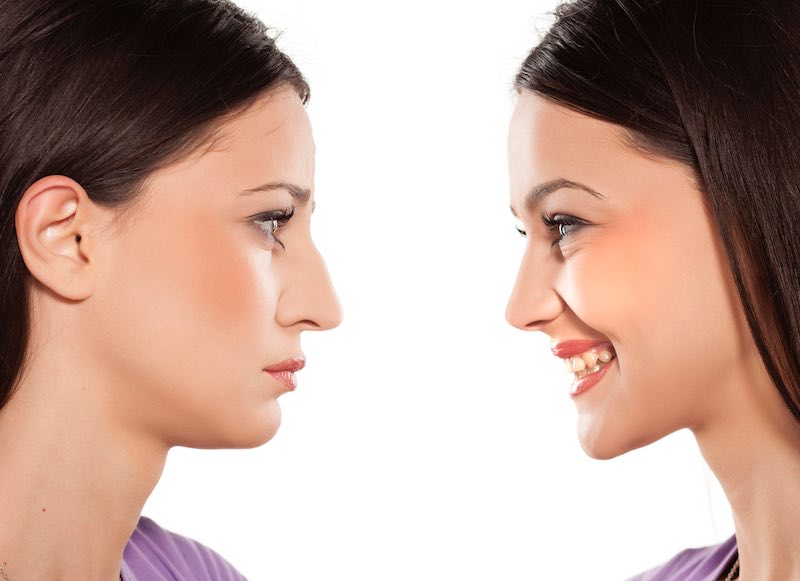 nose surgery