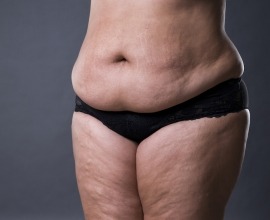 Gastricballoon